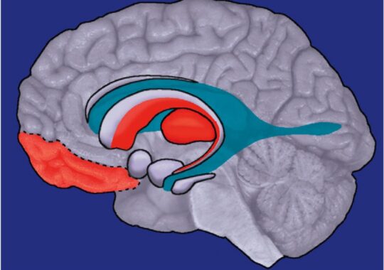 Cerebrum Substance Irregularity Recognized in OCD